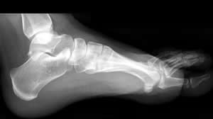 foot x ray
