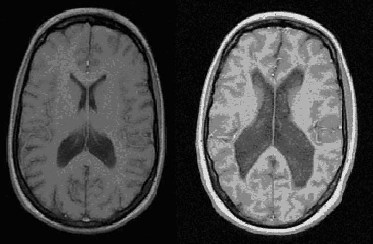 ventricles in a person with schizophrenia
